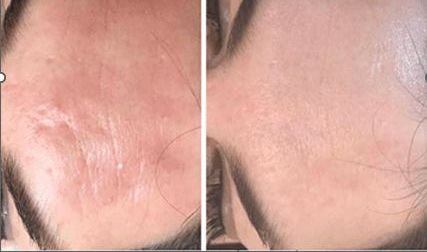 Laser cicatrice avant apr�s