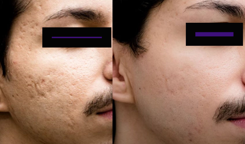 Laser acn� avant apr�s 1