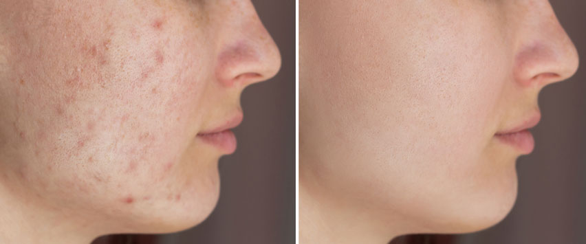 Laser acn� avant apr�s 2