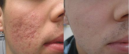 Laser acn� avant apr�s 3