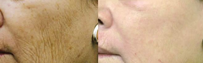 Laser joue avant apr�s 1