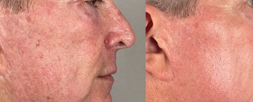 Laser joue avant apr�s 2