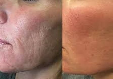 Laser joue avant apr�s 3