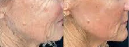 Laser joue avant apr�s 4