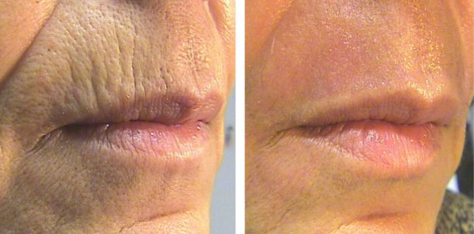 Laser l�vres avant apr�s 1