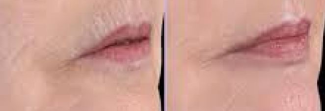 Laser l�vres avant apr�s 2