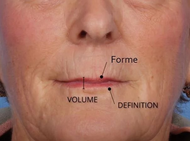 Vieillissement du contour des l�vres